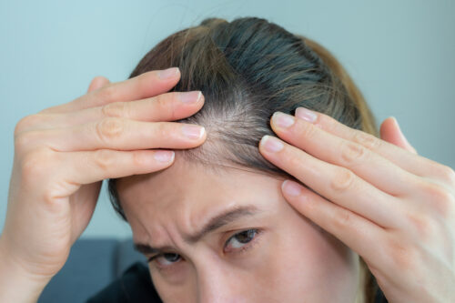 female hair loss due to hormonal imbalance