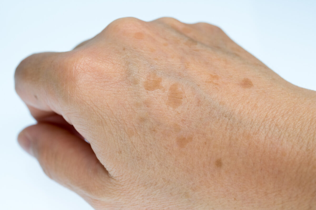 Spots on Skin After Sun burn: Causes, Prevention, and Remedies